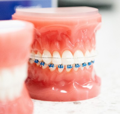 https://www.peakorthodontics.net/wp-content/uploads/2023/07/clear-braces-1.jpg