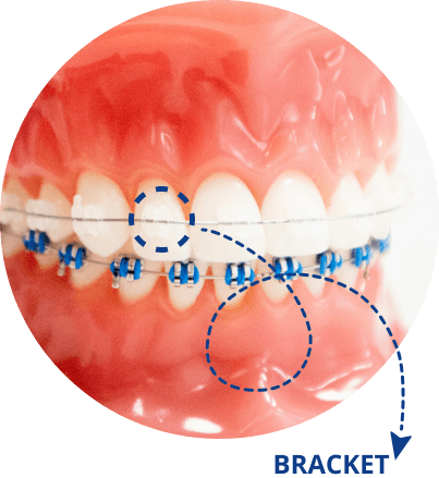 Braces Example