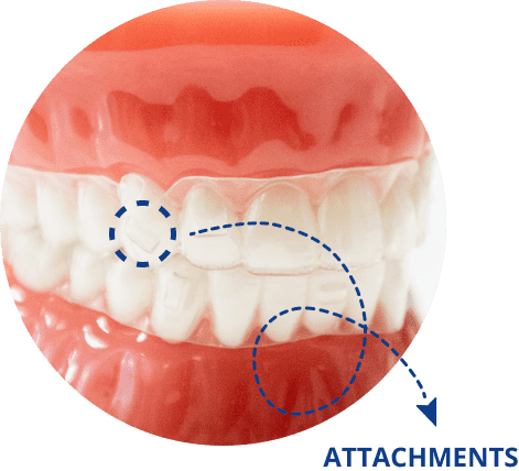 Braces Example