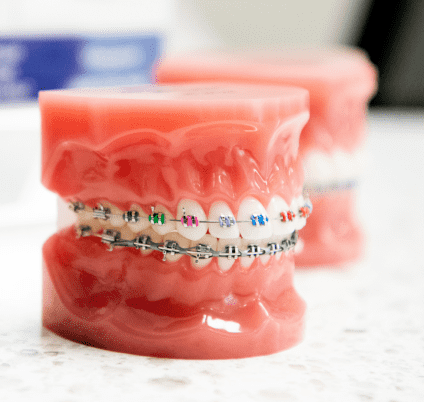 Braces Example