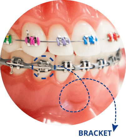 Braces Example